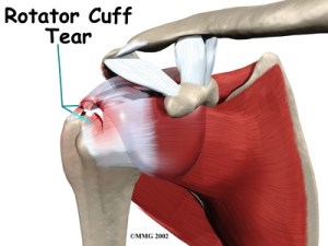 Rotator Cuff