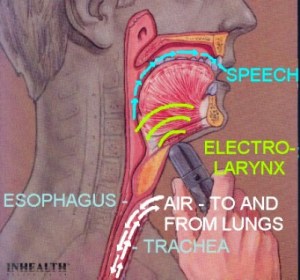 electrolarynx